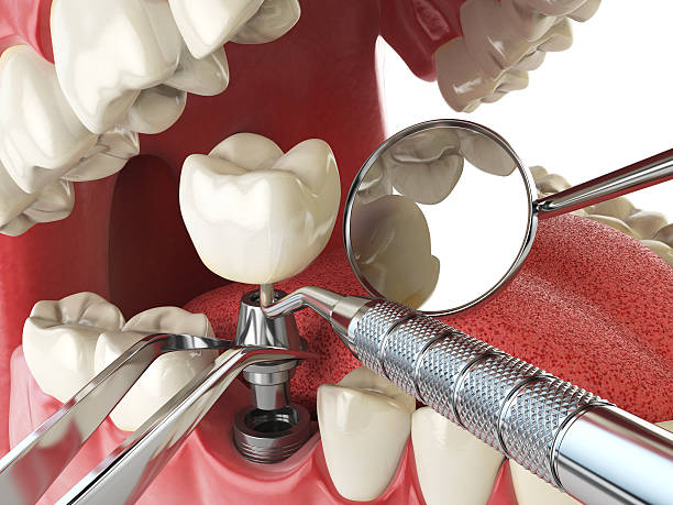 Best Emergency Tooth Extraction in Enterprise, AL